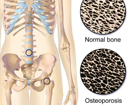 osteoporosis-primaria-osteoporosis-secundaria
