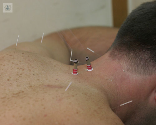 acupuntura92387