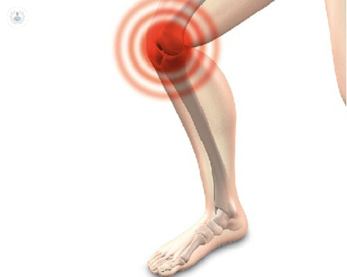 tratamiento-de-la-artrosis-de-rodilla-con-ozonoterapia imágen de artículo