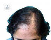 tratamiento-alopecia-femenina