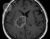 tumor-cerebral-maligno