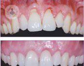 nueva-tecnica-de-cirugia-periodontal-menos-complicaciones-y-mas-resultados