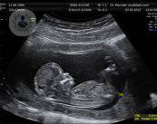 ecografia-embarazo-diagnostico-prenatal