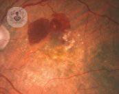 degeneracion-macular-vision-oftalmologia