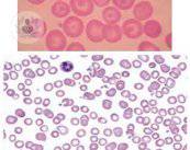 talasemia-vs-anemia-ferropenica