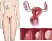 cancer-de-utero-endometrio