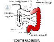 colitis-ulcerosa-tratamientos