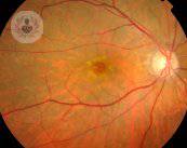 agujero-macular-defecto-retiniano