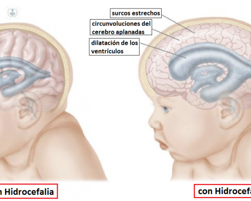 hidrocefalia-tratamiento