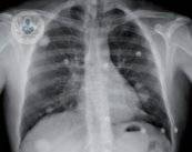 nodulos-pulmonares