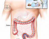 Gastroscopia y colonoscopia para explorar el aparato digestivo