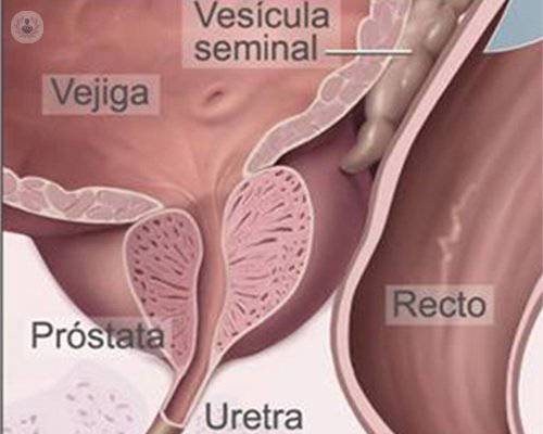 cáncer de próstata que invade una vesícula seminal