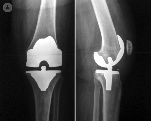 Features of the operation of the knee prosthesis | Top Doctors