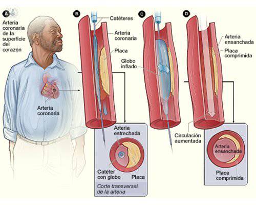 cardiopatia