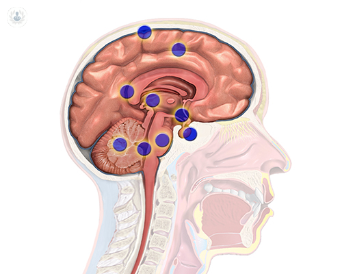 tumores-cerebrales