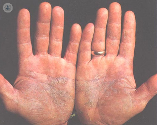 psoriais-manos-enfermedad-piel-personas