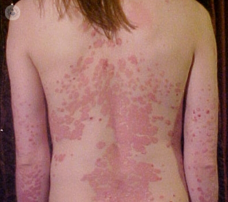 psoriasis-espalda-enfermedad-inflamatoria-piel-degenerativa