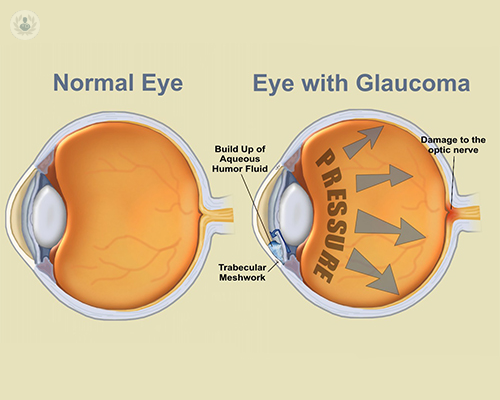 anatomia-ojo-con-y-sin-glaucoma