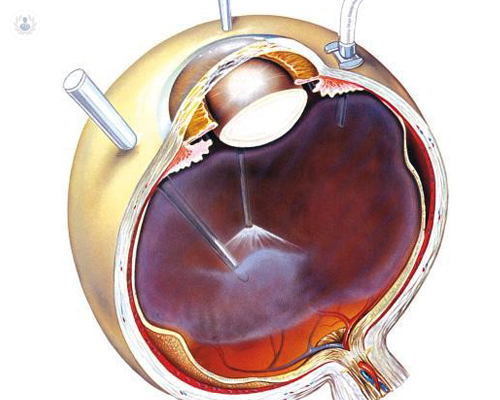 cirugia-ocular-vitrectomia-vitreo-retina-desprendimiento