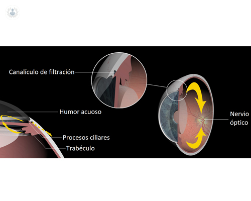 glaucoma-ojo-tratamientos