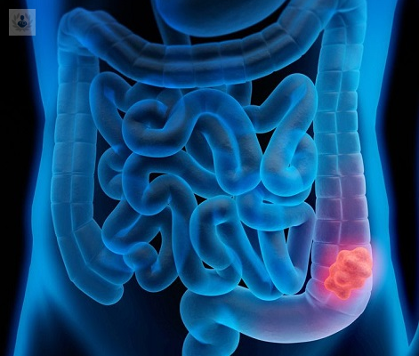 cancer-colorrectal