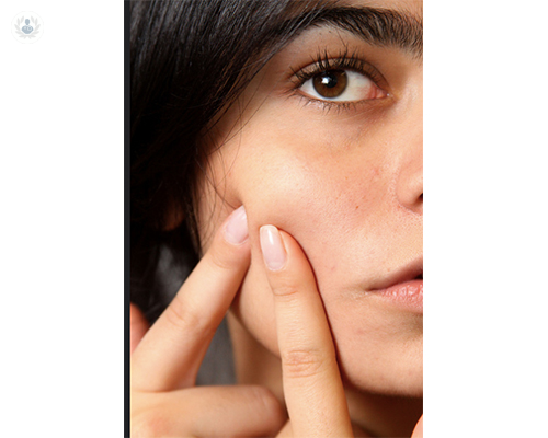 Tratamiento de las cicatrices del acné