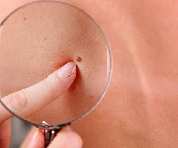 detecta-a-tiempo-un-melanoma-cutaneo imágen de artículo