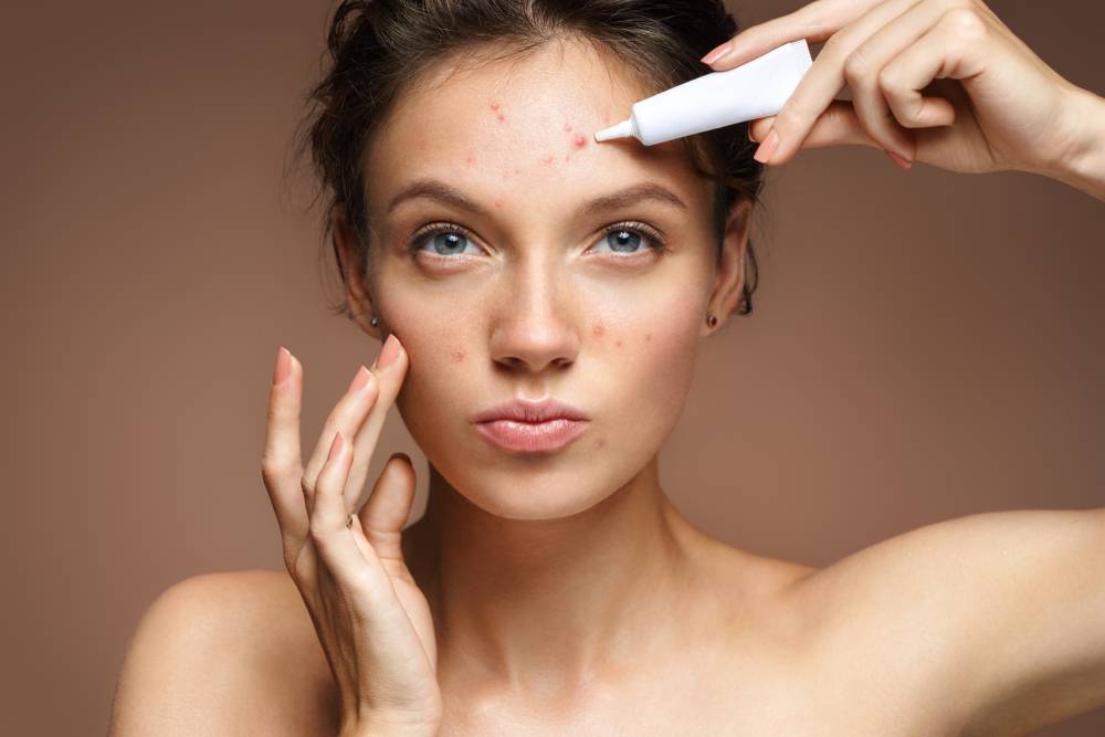 mitos-y-verdades-del-acne imágen de artículo