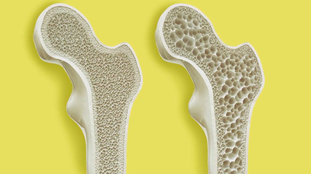 Osteoporosis enfermedad ósea que disminuye la calidad y densidad de
