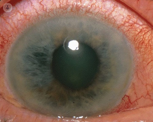 Glaucoma, una ceguera silenciosa