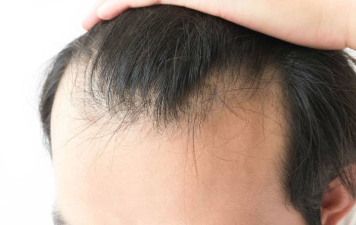 alopecia-problema-que-tratan-los-dermatologos-o-cirujanos-plasticos imágen de artículo
