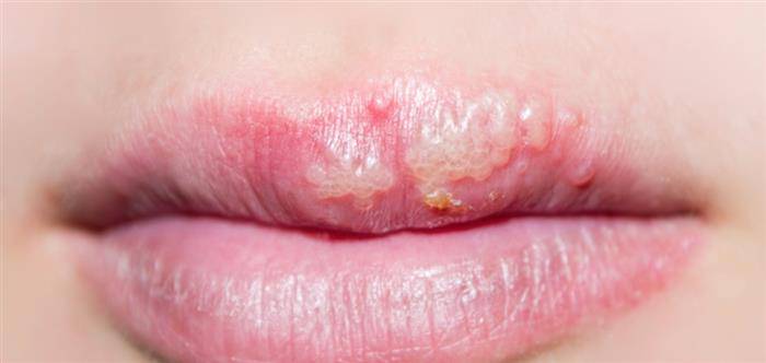 herpes-labial-por-que-ocurre-y-que-se-debe-hacer imágen de artículo