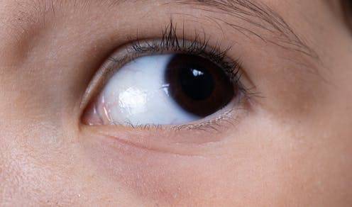 ausencia-del-iris-enfermedad-congenita imágen de artículo