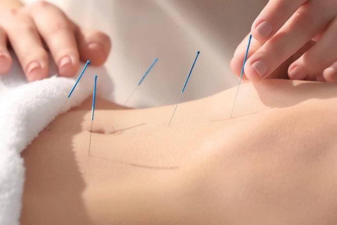 como-saber-si-la-acupuntura-es-para-ti imágen de artículo