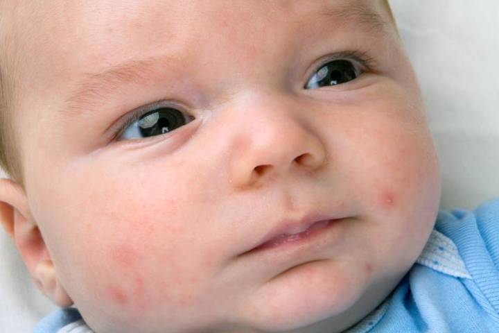 los-bebes-pueden-tener-acne imágen de artículo