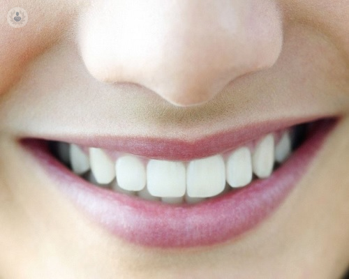 el-blanqueamiento-dental-ayuda-a-eliminar-las-manchas-superficiales imágen de artículo