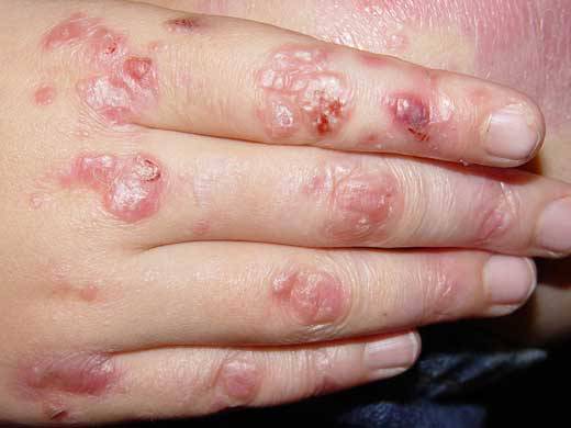 descripcion-de-algunas-genodermatosis-parte-2 imágen de artículo