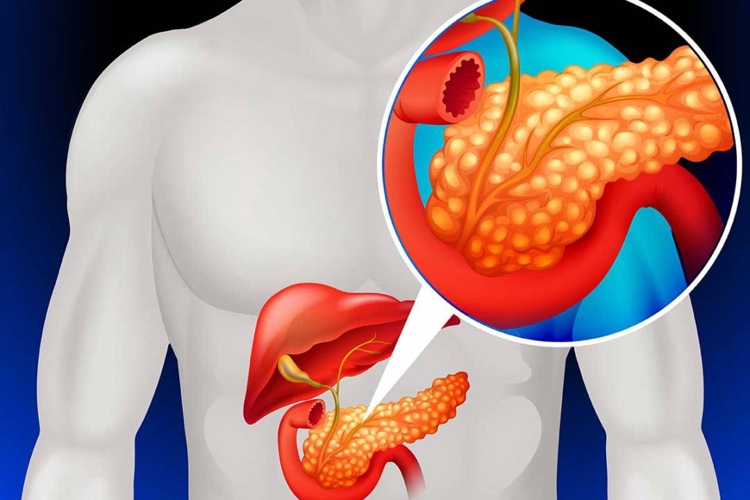 vias-de-abordaje-para-enfermedades-pancreaticas imágen de artículo