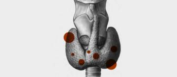 tiroides-cirugia-y-posoperatorio imágen de artículo