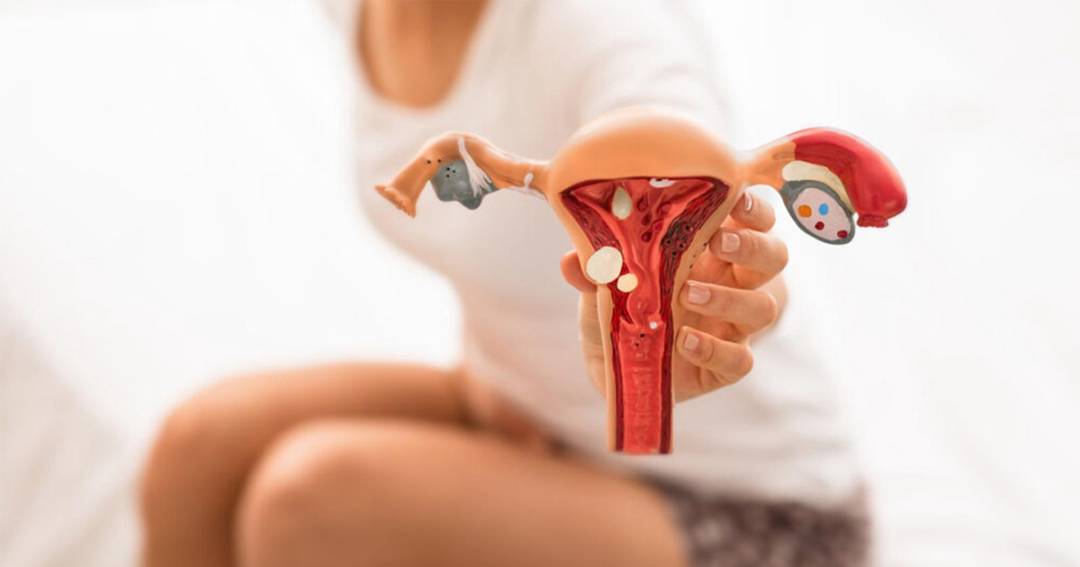 Endometriosis, una Enfermedad Menstrual  
