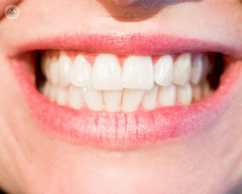 ventajas-y-desventajas-de-la-ortodoncia-lingual-invisible imágen de artículo