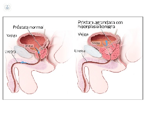 Hiperplasia benigna de próstata, el uso de láser verde como cirugía