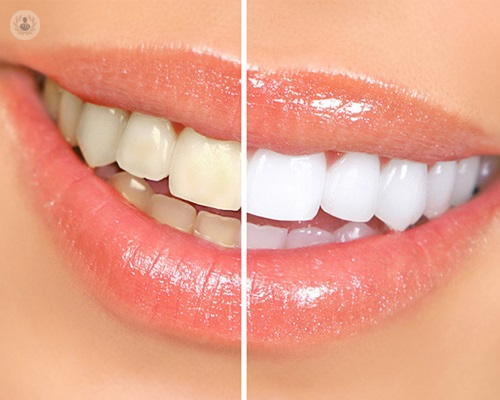 blanqueamiento-dental
