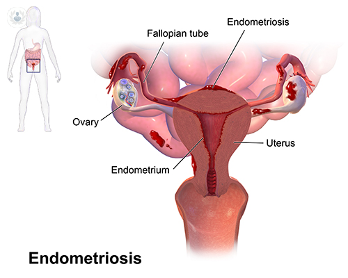 endometriosis