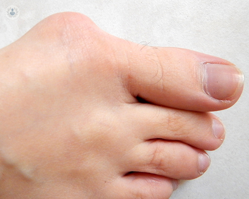 hallux-valgus