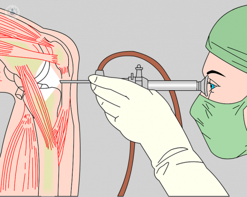artroscopia-rodilla