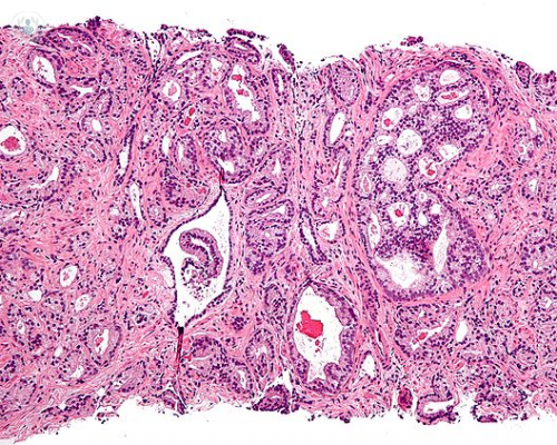 cancer-prostata