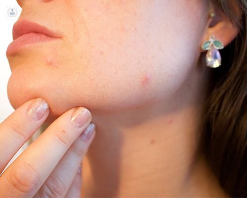 piel-acne