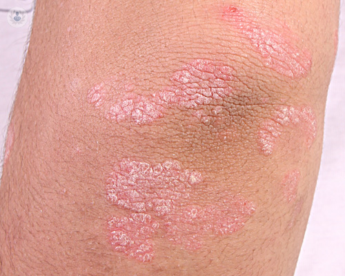 psoriasis