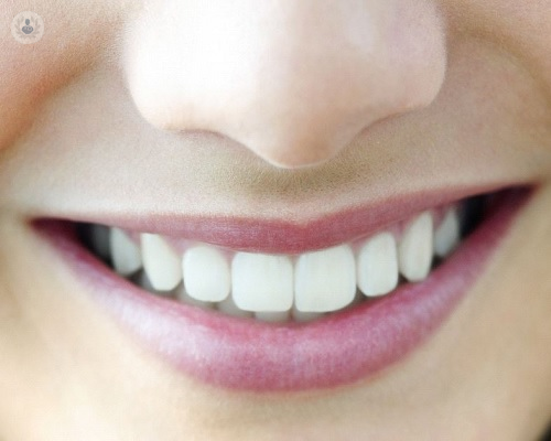 implantes-dentales